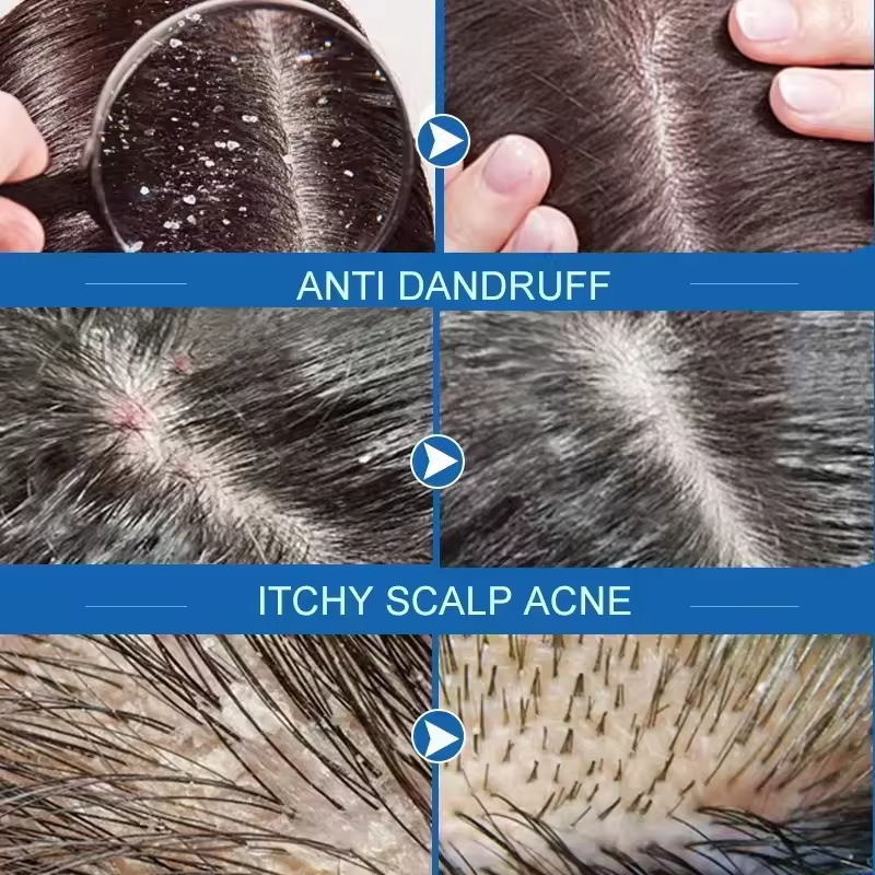 Jabón para tratamiento del cab - Hair Care Dandruff reseña y precio