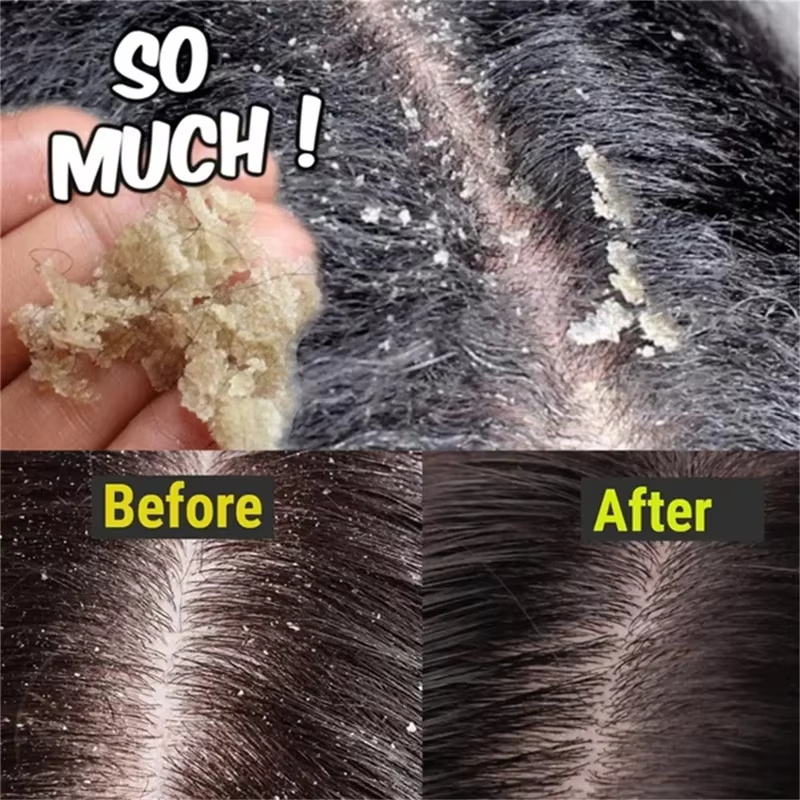 Jabón para tratamiento del cab - Hair Care Dandruff reseña y precio